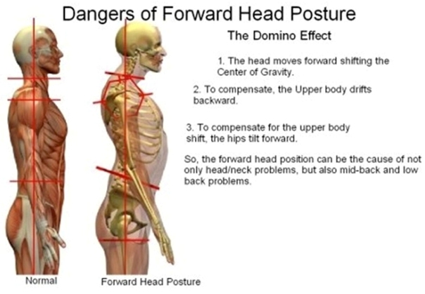 Forward-Head-Posture.167ea62904dd445688976b3b65c96f1c