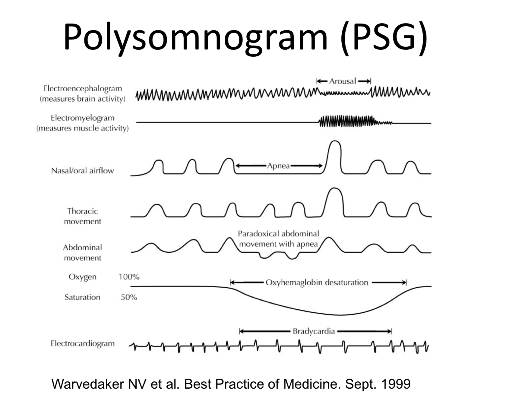 / Polysomnogram s vyznačením typických příznaků epizody spánkové apnoe /